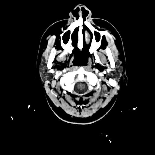 Atretic cephalocele (Radiopaedia 89782-106881 Axial with contrast 9).jpg