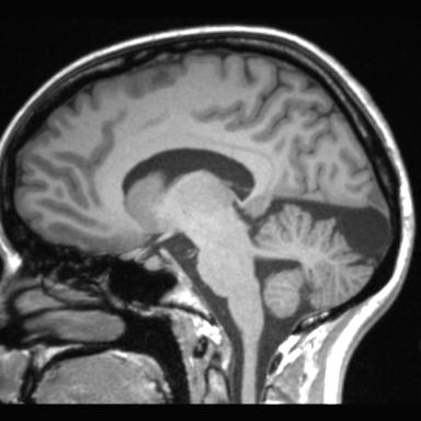 Atretic encephalocoele with inferior vermis hypoplasia (Radiopaedia 30443-31108 Sagittal T1 73).jpg