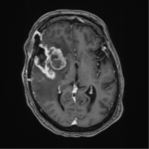 File:Atypical meningioma (WHO Grade II) (Radiopaedia 54742-60981 Axial T1 C+ 34).png
