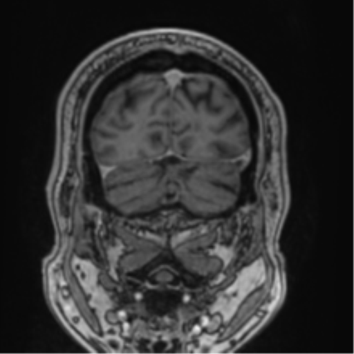 Atypical meningioma (WHO grade II) with brain invasion (Radiopaedia 57767-64729 Coronal T1 C+ 73).png