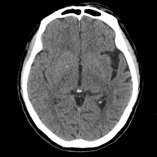 Atypical meningioma (WHO grade II) with osseous invasion (Radiopaedia 53654-59715 Axial non-contrast 26).png