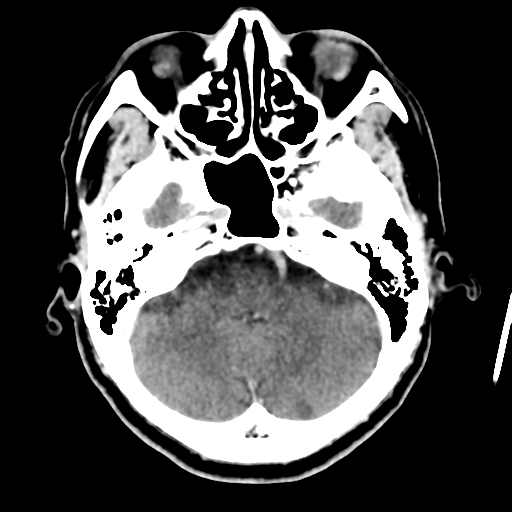 Atypical meningioma with skull invasion (Radiopaedia 34357-35649 Axial C+ delayed 14).png