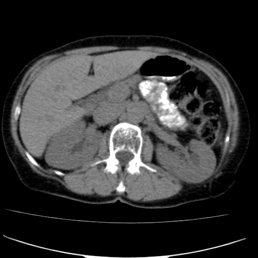 File:Atypical renal cyst (Radiopaedia 17536-17251 non-contrast 12).jpg