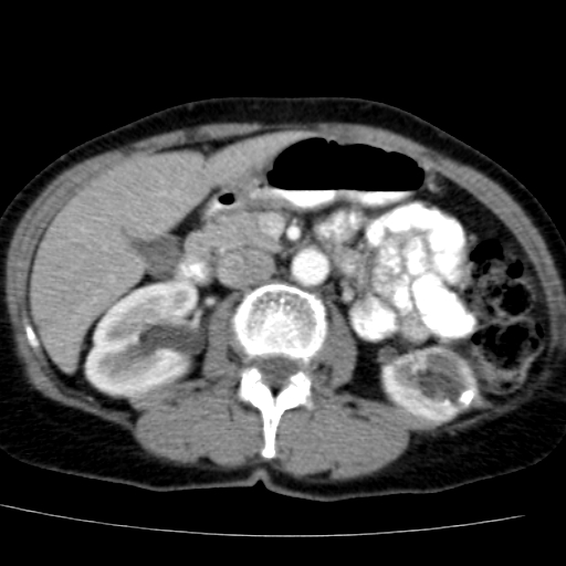 File:Atypical renal cyst (Radiopaedia 17536-17251 renal cortical phase 18).jpg
