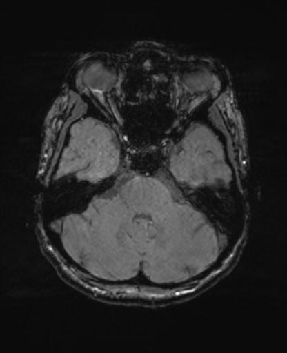 File:Autoimmune limbic encephalitis (Radiopaedia 30363-31005 SWI - magnitude 21).jpg