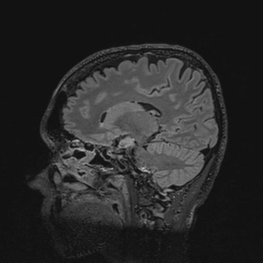 Autoimmune limbic encephalitis (Radiopaedia 30363-31005 Sagittal FLAIR 67).jpg