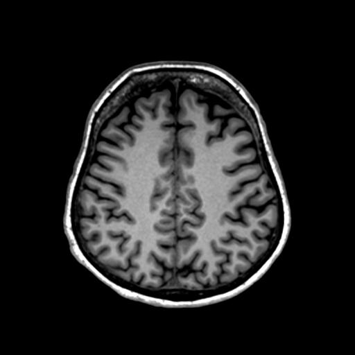 Autoimmune limbic encephalitis (Radiopaedia 30363-31005 T1 Axial 1mm 108).jpg