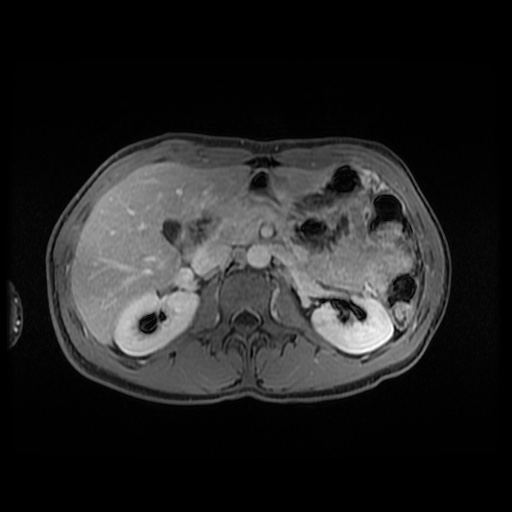 Autoimmune pancreatitis (Radiopaedia 69751-79729 Axial T1 C+ fat sat 65).jpg
