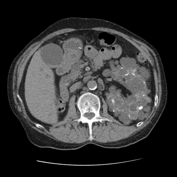 Autosomal dominant polycystic kidney disease (Radiopaedia 27851-28094 Axial non-contrast 68).jpg