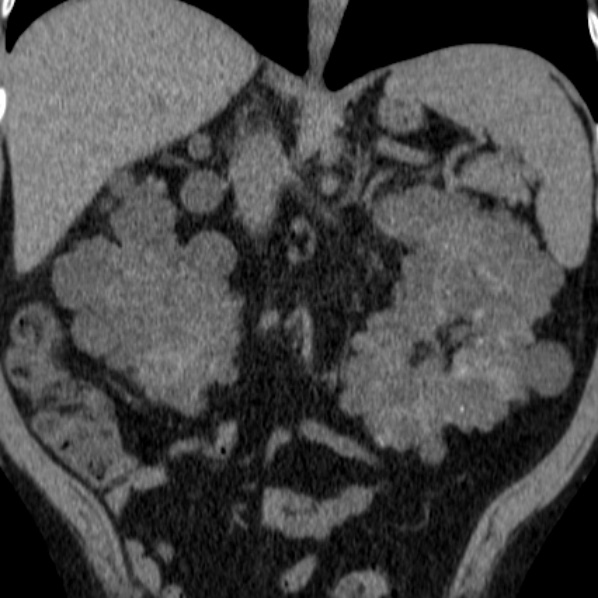 File:Autosomal dominant polycystic kidney disease (Radiopaedia 36539-38101 Coronal non-contrast 21).jpg