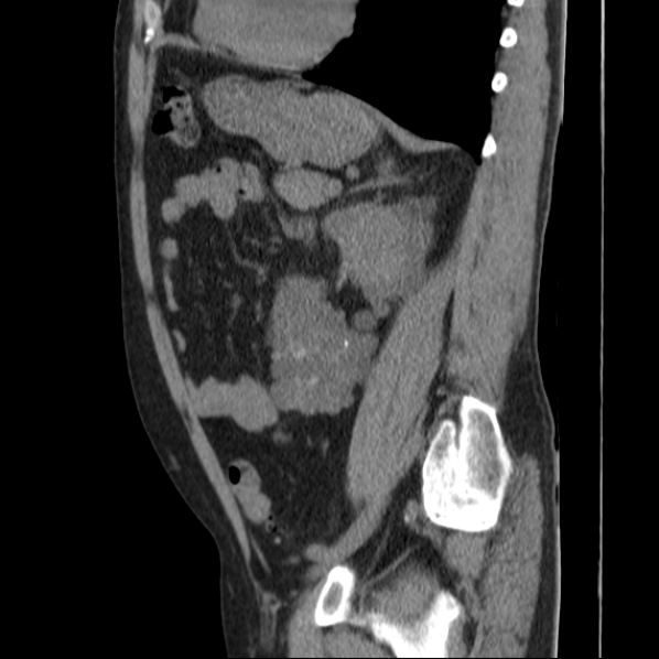 Autosomal dominant polycystic kidney disease (Radiopaedia 36539-38101 D 55).jpg