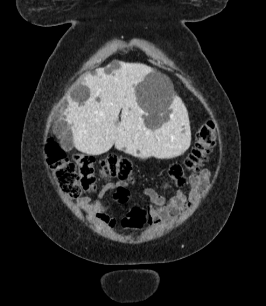 Autosomal dominant polycystic kidney disease (Radiopaedia 57124-64017 B 11).jpg