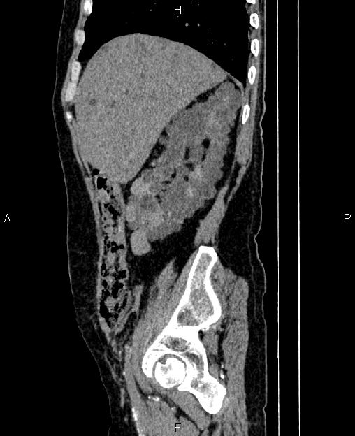 Autosomal dominant polycystic kidney disease (Radiopaedia 87830-104287 C 21).jpg