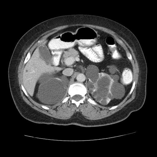 Autosomal dominant polycystic kidney disease with hepatic involvement (Radiopaedia 32693-33662 B 26).jpg
