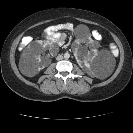 File:Autosomal dominant polycystic kidney disease with hepatic involvement (Radiopaedia 32693-33662 B 43).jpg