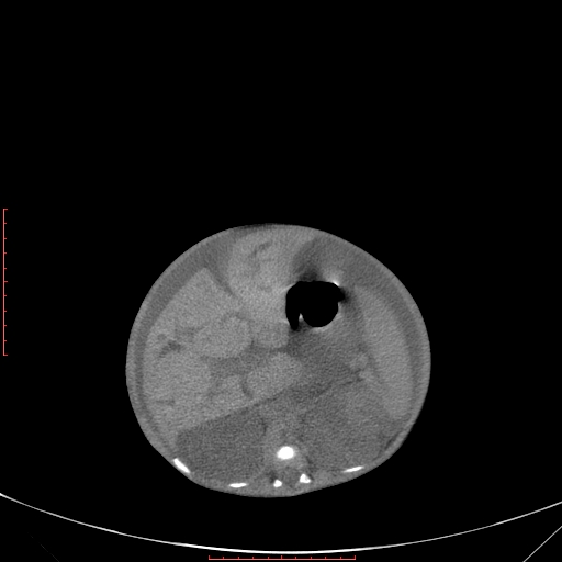 Autosomal recessive polycystic kidney disease associated with Caroli disease (Radiopaedia 61932-69984 B 167).jpg