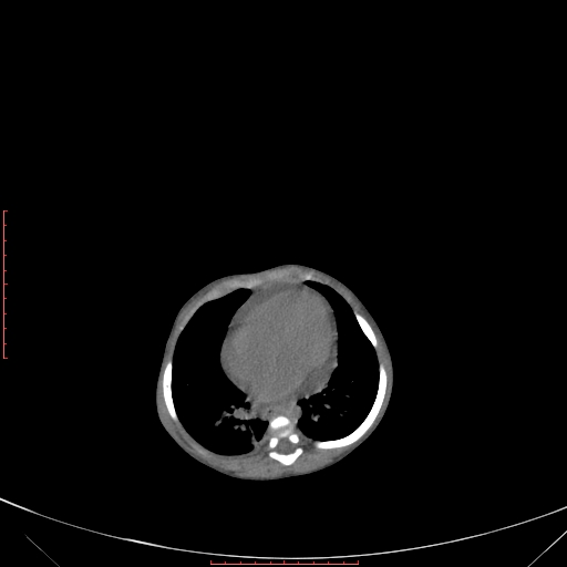 Autosomal recessive polycystic kidney disease associated with Caroli disease (Radiopaedia 61932-69984 B 85).jpg