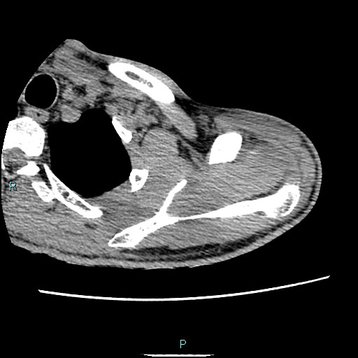 File:Avascular necrosis after fracture dislocations of the proximal humerus (Radiopaedia 88078-104653 D 23).jpg