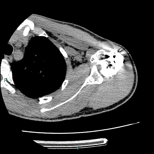 Avascular necrosis after fracture dislocations of the proximal humerus (Radiopaedia 88078-104655 D 54).jpg
