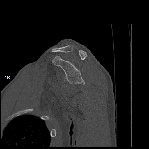 Avascular necrosis after fracture dislocations of the proximal humerus (Radiopaedia 88078-104655 Sagittal bone window 33).jpg