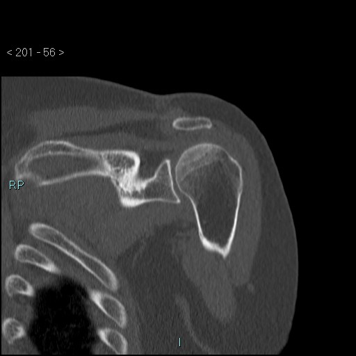 Avascular necrosis of the shoulder - Cruess stage I (Radiopaedia 77674-89887 Coronal bone window 55).jpg
