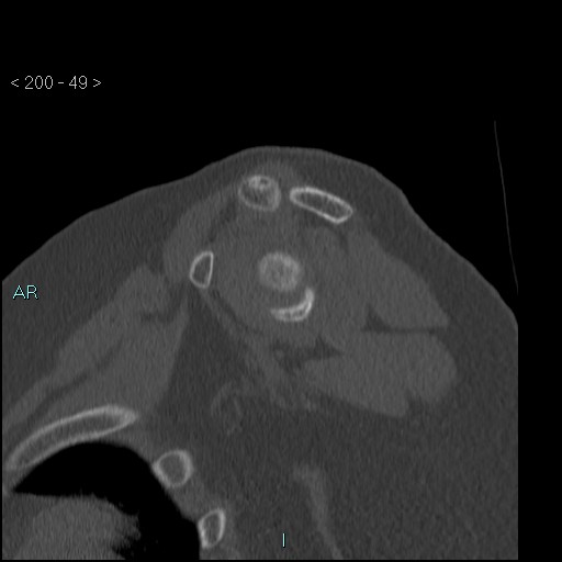 Avascular necrosis of the shoulder - Cruess stage I (Radiopaedia 77674-89887 Sagittal bone window 48).jpg