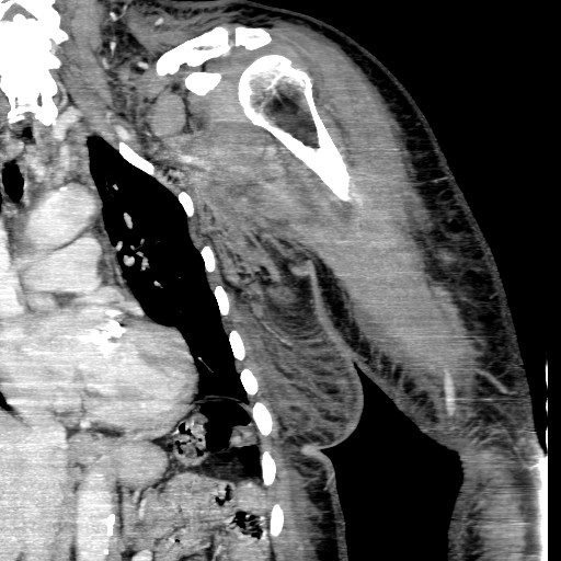File:Axillary arterial pseudoaneurysm (Radiopaedia 24925-25195 B 1).jpg