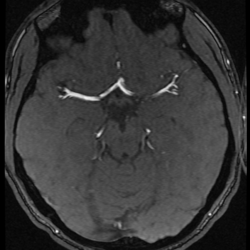 File:Azygos anterior cerebral artery (Radiopaedia 17059-16756 Axial MRA 40).jpg