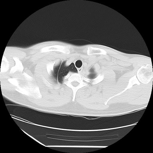 Azygos fissure (Radiopaedia 88181-104784 Axial lung window 3).jpg