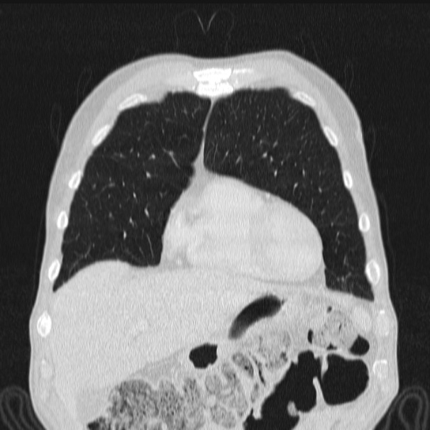 Azygos lobe (Radiopaedia 38259-40275 Coronal lung window 19).jpg