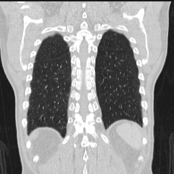 Azygos lobe (Radiopaedia 38259-40275 Coronal lung window 65).jpg
