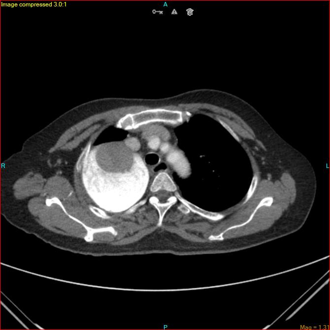 Azygos vein aneurysm (Radiopaedia 77824-90130 B 16).jpg