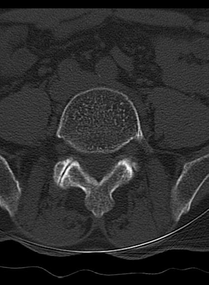 File:Baastrup syndrome (Radiopaedia 64891-73838 Axial bone window 10).jpg