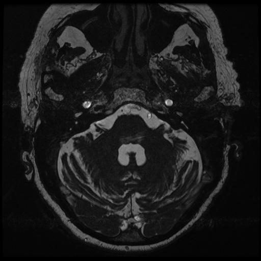 File:Balo concentric sclerosis (Radiopaedia 53875-59982 Axial T2 FIESTA 27).jpg