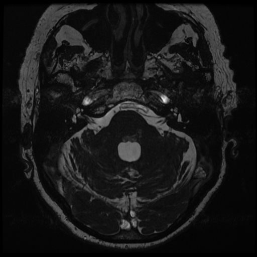 File:Balo concentric sclerosis (Radiopaedia 53875-59982 Axial T2 FIESTA 34).jpg