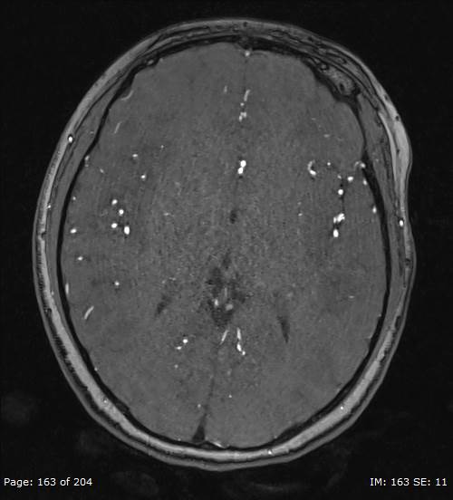 Balo concentric sclerosis (Radiopaedia 61637-69636 Axial MRA 163).jpg