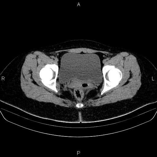 Bartholin gland cyst (Radiopaedia 62635-70930 Axial non-contrast 64).jpg