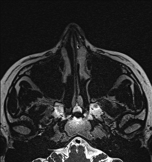 Basal cell carcinoma - nasal region (Radiopaedia 70292-80365 Axial Gradient Echo 22).jpg