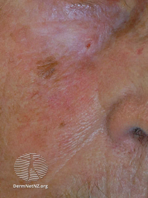 Basal cell carcinoma affecting the face (DermNet NZ lesions-bcc-face-0742).jpg