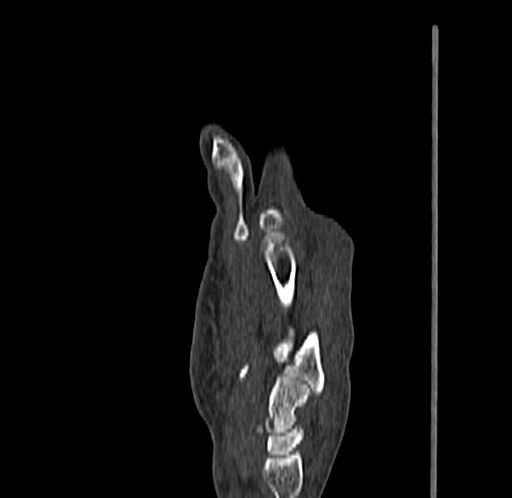 Base of 2nd metacarpal fracture (Radiopaedia 73741-84544 Sagittal bone window 44).jpg