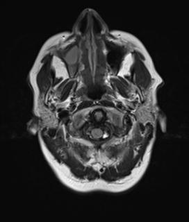 File:Base of skull chondrosarcoma (Radiopaedia 30410-31070 Axial FLAIR 1).jpg
