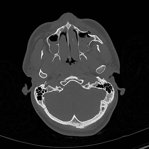 Base of skull fracture with bilateral Le Fort fractures (Radiopaedia 47094-51638 Axial bone window 21).jpg