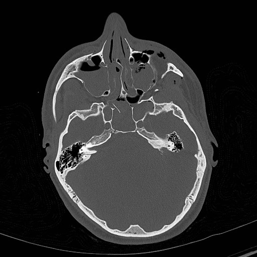 Base of skull fracture with bilateral Le Fort fractures (Radiopaedia 47094-51638 Axial bone window 32).jpg