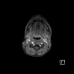 Base of skull rhabdomyosarcoma (Radiopaedia 32196-33142 T1 C+ fat sat 5).jpg
