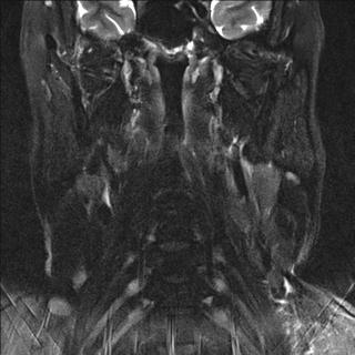 File:Base of tongue squamous cell carcinoma (Radiopaedia 31174-31884 Coronal T2 fat sat 7).jpg
