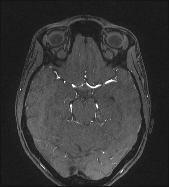 Basilar artery perforator aneurysm (Radiopaedia 82455-97733 Axial MRA 101).jpg