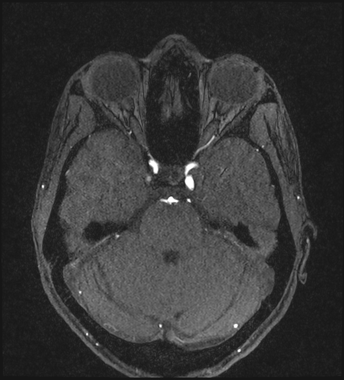 Basilar artery perforator aneurysm (Radiopaedia 82455-97733 Axial MRA 85).jpg