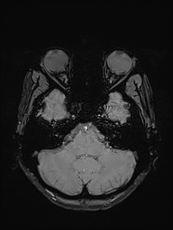 Basilar artery perforator aneurysm (Radiopaedia 82455-97733 Axial SWI 11).jpg