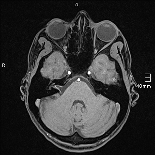 Basilar artery perforator aneurysm (Radiopaedia 82455-99523 F 32).jpg