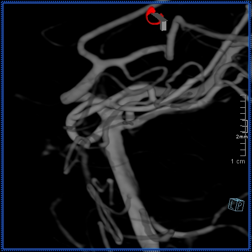 Basilar artery perforator aneurysm (Radiopaedia 82455-99524 3D Left VA 10).jpg